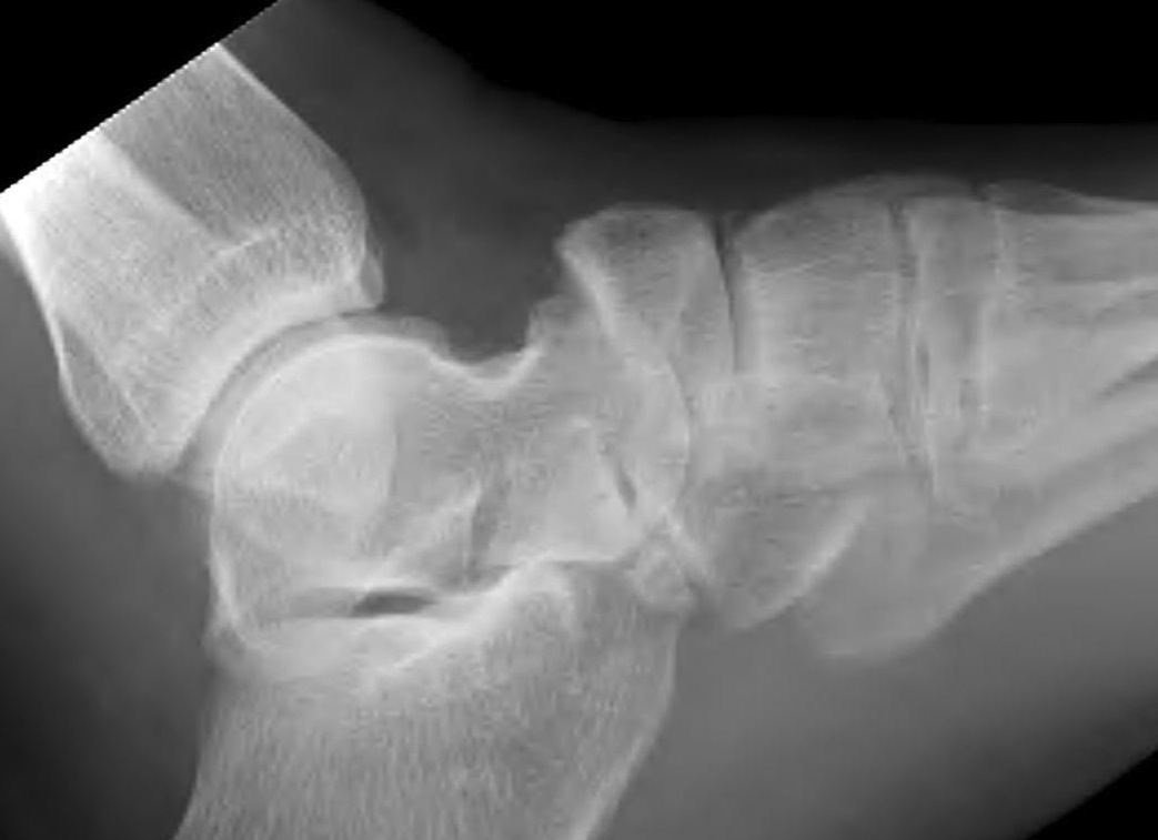 Displaced Navicular Fracture